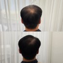 강은미피부관리 | 하남탈모커버 하남헤어라인 하남SMP 정수리 본스칼프
