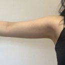 더에스핏 | 에스핏주사 후기 20대 후반 여성 팔뚝살 지방분해주사 경험담