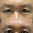 [부산 미간주름 시술] 쥬브젠 미간주름 시술 과정: 상담부터 시술까지 Step-by-Step 완벽 가이드
