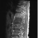 골다공증성 압박골절 이미지