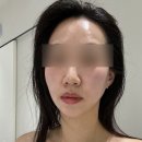서현메디칼 | 분당 서현피부관리ㅣ디율에스테틱 써마웨이브 리프팅 후기 (팔자주름, 중안부 고민)
