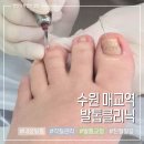 수원-1752 | 수원 매교역 발톱클리닉 내성발톱 교정 쫙 핀 후기