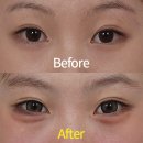 생글생글한의원 | 애교필러, 자연스러운 볼륨을 원한다면 쥬비덤!
