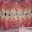 성남 청소년 주걱턱, 수술 없이 교정 치료로 개선한 사례 (연세미소치과)