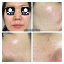 티나성형외과의원 | 피부과 물광톡스 ] 부산진구 서면역 성형외과 피부과 OOO의원에서 여드름 흉터자국 개선 물톡스 시술...