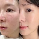 드림한방병원 | 압구정피부과전문의한테 엑소스마트 받고옴! 자가엑소좀 효과, 가격, 전후 사진 비교 보여드림!