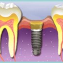 [임플란트] 임플란트 치료방법 설명과 주의사항 안내. 이미지