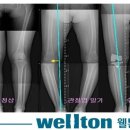 무릎인공관절수술 잘하는 곳// 무릎인공관절 오래 쓰는 방법 이미지