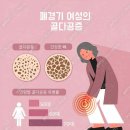 여성호르몬 줄어들수록 커지는 골다공증 위험...뼈 건강 지키려면? 이미지