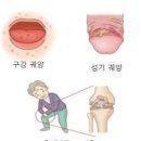 자가면역질환 종류 베체트병 증상 원인 검사 치료 이미지