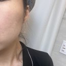 준피부과의원 | [잠실 피부과] 석촌역 에스준피부과 점 빼기 1주 후 찐후기(내돈내산)