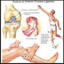 전방십자인대 부분파열후 보존적 재활운동 [영상첨부] 이미지