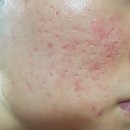 심지한의원 | 새살침 내돈내산 흉터 전문 한의원 재생 관리 후기