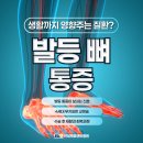 연세백퍼센트병원 | 발등 뼈 통증 생활까지 영향주는 원인 질환은