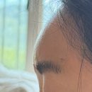 대덕대로 | 대전 이마필러 :: 바노바기의원 대전점 주름개선 이마필러 후기