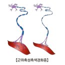 근위축성 측생 경화증(루게릭병) 이미지