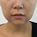 바라던 핏 | 신논현역피부과 바라던핏 얼굴 지방분해주사 후기 / 내돈내산 윤곽주사 전후