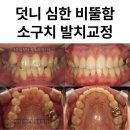 건강한정치과의원 | 덧니 교정 · 공간이 부족한 심한 비뚤함에 발치교정이 필요한 이유. 가락동 교정치과