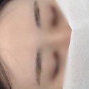 민메디컬 | 인천브로우샵 아름답다 허쉬 눈썹 잔흔제거 추천 후기!