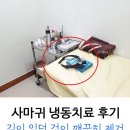 성광전기냉동 | 사마귀 냉동치료 후기 : 깨끗히 제거되다 (티눈 · 통증)