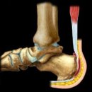 발목 발의 통증- 족관증후군, 무지외반, 아킬레스건 이미지