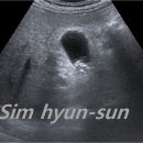 5일 전부터 Epigastric pain (65/M)... 진단명은? 이미지