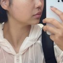 필업 | 신사역피부과 필업 콜라겐볼륨 옆볼패임 10일 차 후기