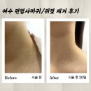 여수연합의원 | 여수 편평사마귀/쥐젖 제거 후기, 서울 연합의원 내돈내산