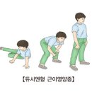 듀시엔형 근이영양증 (Duchenne muscular dystrophy) 이미지