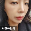 바로서기정한의원 | 부산 서면 한의원 티타늄리프팅 BTS 효과 느낀 내돈내산 솔직 후기