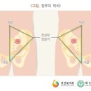 항문 괄약근의 기능장해로 인공항문을 설치한 경우[흉복부장기 또는 비뇨생식기 기능에 약간의 장해를 남긴 때(20%)] 이미지