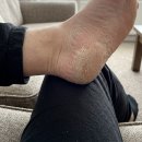 하얀장갑 | 화사 발뒤꿈치 눈사람장갑 우레아 에센스 사용 후기