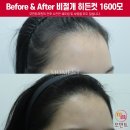 히든헤어 - 해운대구 | 20대 여성 비어있는 헤어라인교정 비절개히든컷 1600모 10개월 후기