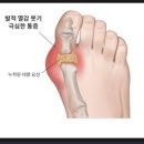 통풍의 자기진단[요산수치가 6mg/dl 이상이다] 이미지