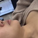 웨이브건 | 압구정로데오역 피부과 엑셀웨이브 효과 본 후기