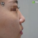 이비인후과 대구 달성군 기능형 코성형 만족스러운 코수술을 원한다면 [전/후 비교] 이미지