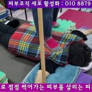 무서운 피부암(癌)으로 점점 썩어가는 피부를 살리는 피부 특수 치료법 이미지