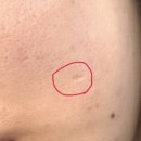 후한의원 | 새살침 3회차 후기｜후한의원 수원 트랜스테라피 내돈내산 여드름 흉터