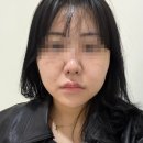 6전6회 | 유라인클리닉 윤곽주사 이중턱 정리 브이컷주사 마지막 6회차 후기(전후 사진 비교)