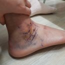 바코 메드 | 발목 수술 후기 / 브로스트롬 인대 봉합술 / 전거비인대 파열, 외측 발목 불안정성