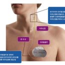 여에스더 우울증, 많이 좋아졌어요 (난치성우울증, 우울증치료, 전기경련치료, ECT, 에스케타민, 스프라바토) 이미지