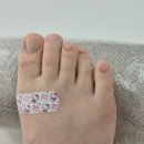 장안3 | 동대문구 바이오풋케어 장안점 방문 후기(내성발톱, 무좀발톱 관리)