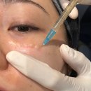 어머멍 | 수원피부과 자가혈 스킨부스터 셀스킨주사 후기