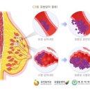 유방암으로 인한 유방수술보장 특별약관 이미지