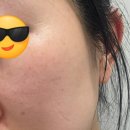 더유앤아이파트너스 | [김포] 유앤아이피부과 시술 후기.출산 후 얼굴 잡티, 색소 고민 해결기