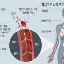 건강의 적신호, 멍드는이유 이미지