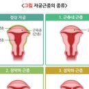 자궁근종 자궁근종 원인 증상 자궁 물혹 원인 자궁근종 주요증상 자궁근종 치료 다발성 자궁근 이미지