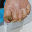 레푸스앤스타일 일산장항점 | 일산 내성발톱 무좀 90대 어르신 관리한 케어 후기