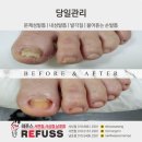 레푸스 사상점 네이버블로그