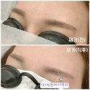 앞산네거리(티브로드 방면) | 눈썹문신제거 아닌 반영구제거 꼬리두개 1회 제거 리얼후기 [since2008 티나는아름다운라인]